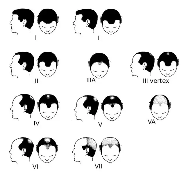 norwood scale