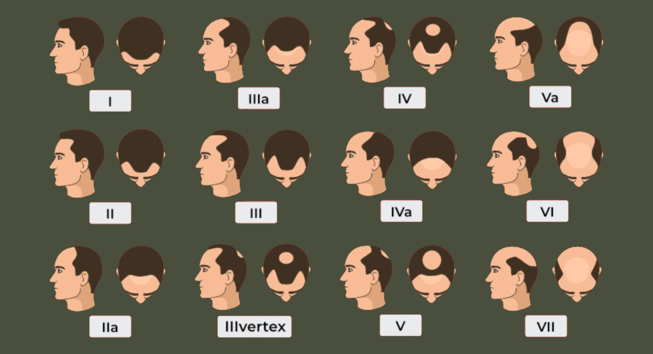 The Norwood Scale for Hair Loss: What It Means for You 1 norwood bg 4A4F3D